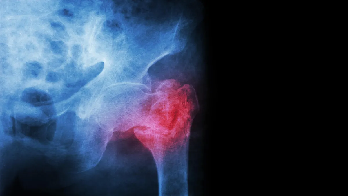 Trait: Bone mineral density (VDR)